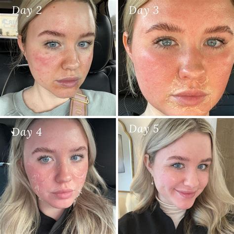 Chemical Peels .